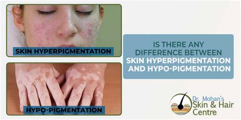 Is There Any Difference Between Skin Hyperpigmentation And Hypo