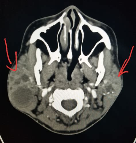Face Ct Parotid Cysts Lymphoepithelial In Patient With Aids
