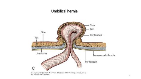 Umbilical Paraumbilical Hernia Saral