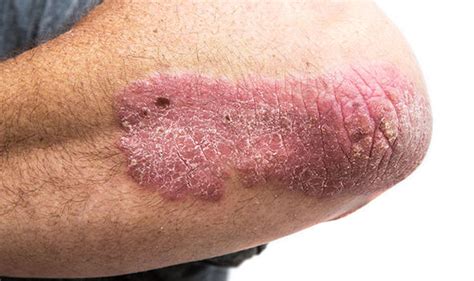 Psoriasis What Is The Dry Skin Condition Symptoms And Treatment