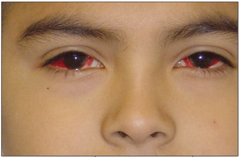 Traumatic Subconjunctival Hemorrhage Causes Symptoms And Treatment