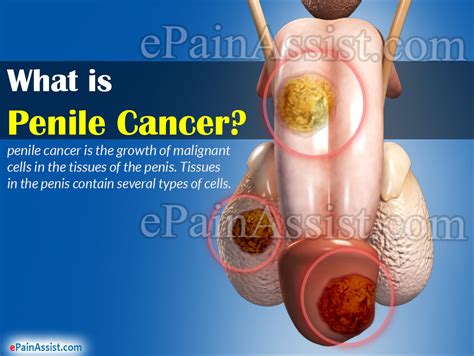 Warning Signs Of Penile Cancer And Its Diagnosis
