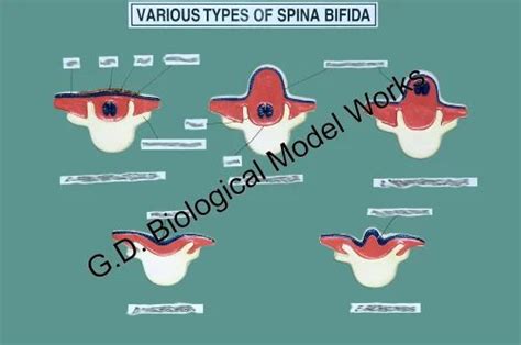 Various Type Of Spina Bifida Embryology Model At Rs 2500 Medical