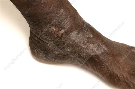 Varicose Eczema Stock Image C0501010 Science Photo Library