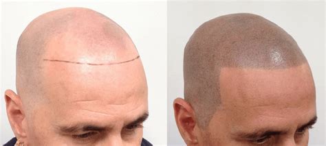 Acne hair loss allergy cosmetic treatment. Hair Loss Solutions: Could This Eczema Drug Help Treat ...
