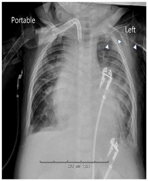 Cephalic Peripherally Inserted Central Catheter Placement With