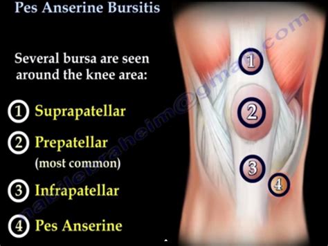 Pes Anserine Bursitis OrthopaedicPrinciples Com