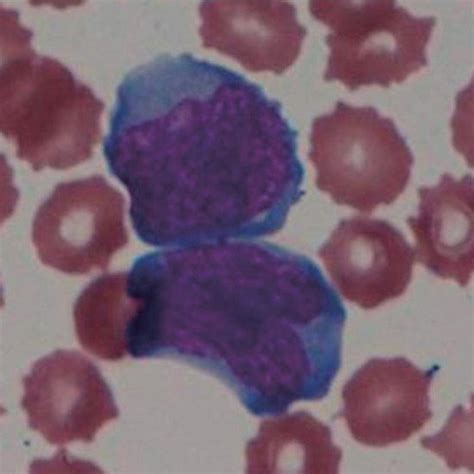 Atypical Lymphocytes Detected In The Patients Peripheral Blood For 17