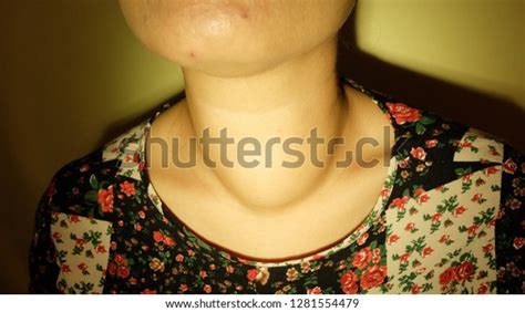 Diffuse Anteeior Neck Swelling Goitre Stock Photo 1281554479 Shutterstock