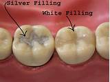 Dental Silver Fillings Photos