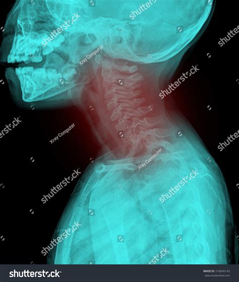 Xray Neck Cervical Spine Lateral Stock Photo 216045142 Shutterstock