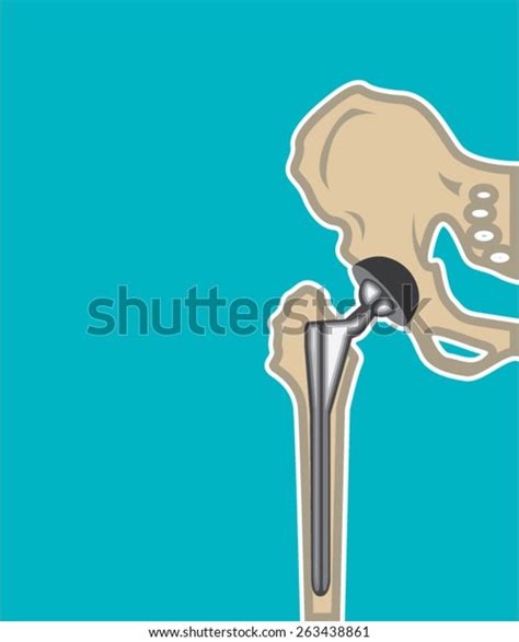 Hip Joint Replacement Stock Vector Royalty Free 263438861 Shutterstock