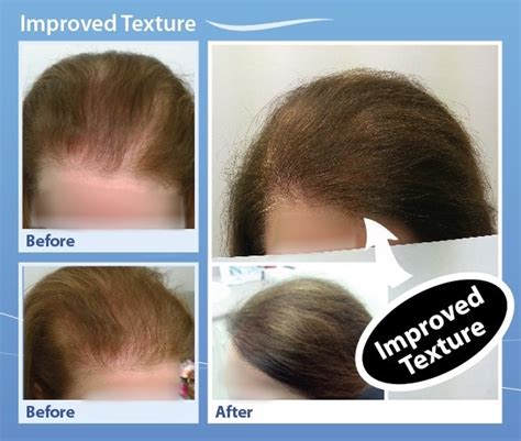 Hair thinning occurs for all the hair strands over the scalp area. Help Hair Shake Before and After Pictures for Hair Loss