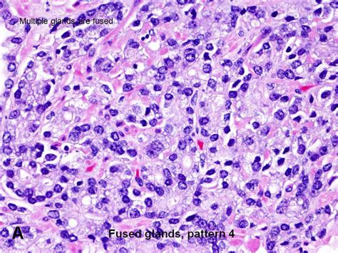 Adenocarcinoma Acinar Usual Gleason 3 4 7