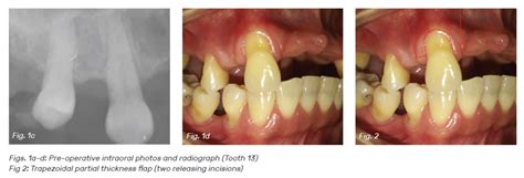 Root Coverage On A Gingival Recession Type 2 Dental Asia