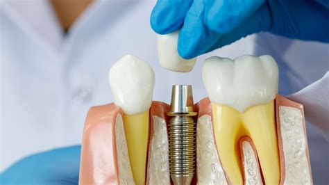 What Are Dental Implants Everything You Need To Know Byford Smiles