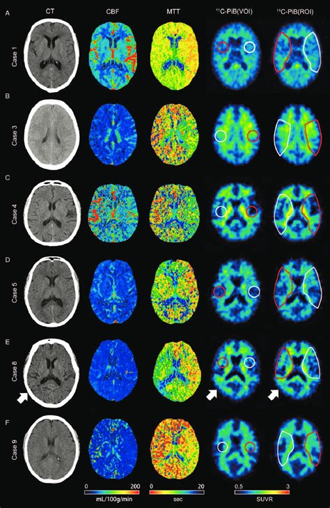 Representative Multimodal Imaging Of Six Patients Images Of Patients