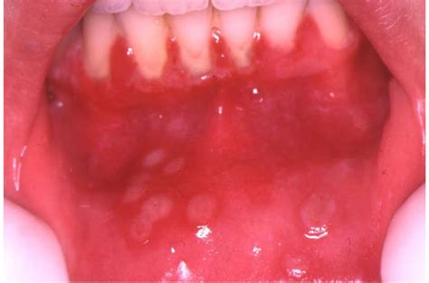 Herpes Simplex Virus Hsv Infection Of The Mouth European