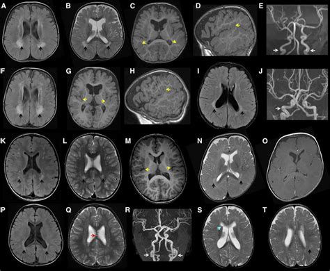 Mri Brain Abnormalities In Individuals With Pcgf2 Mutations A E Axial