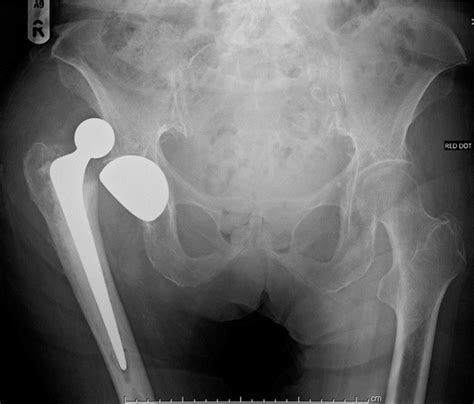 Dislocated Hip Replacement Orthosho