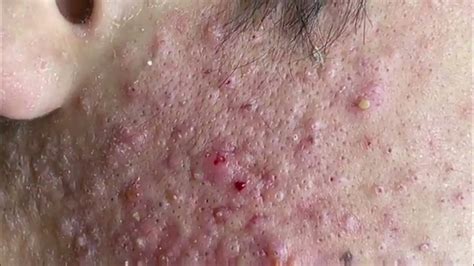 Satisfying And Relaxing With Squeezing Acne Acne Severe Hidden Acne