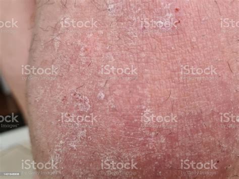 Red Scaly Allergic Eczema Is Rash That Is Inflamed And Itchy On Skin