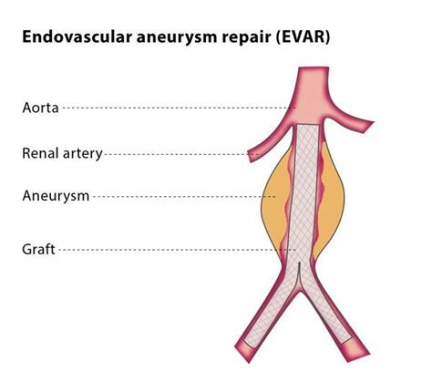 Endovascular Treatment Of Abdominal Aortic Aneurysms Evar