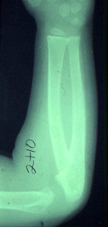 Congenital Radial Ulnar Synostosis Hand Orthobullets
