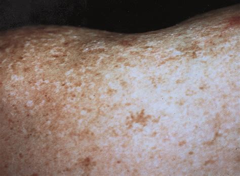 Hypopigmented Papules Of The Cheeks Neck And Shoulders Dermatology