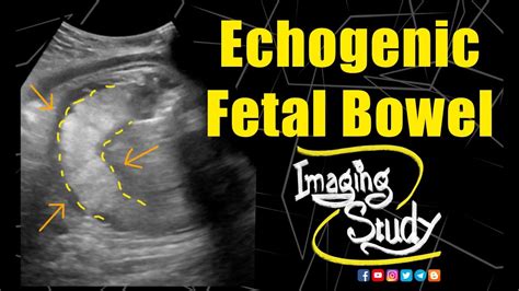 Echogenic Fetal Bowel Ultrasound Case 141 Youtube