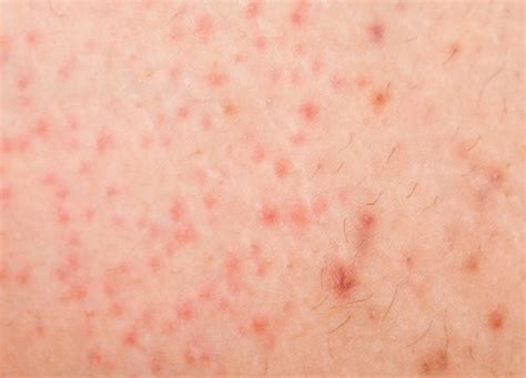 Skin Conditions We Treat Mesa Az Sagebrush Dermatology