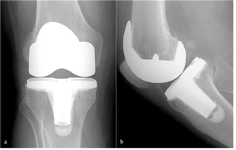 Me Han Dicho Que Tengo Prótesis De Rodilla