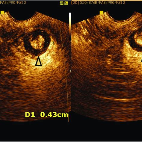 Two Dimensional Endoanal Ultrasound Image Of Occult External Anal