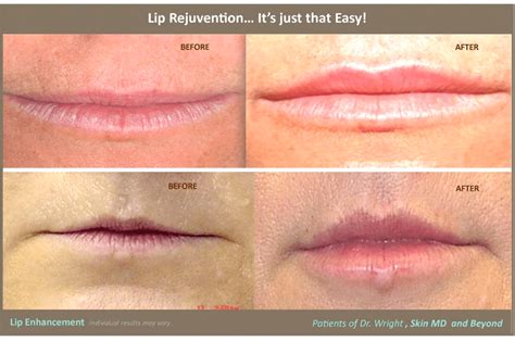 Thin Lips Treatment Plano, TX | Flat Lips Treatment Frisco, TX