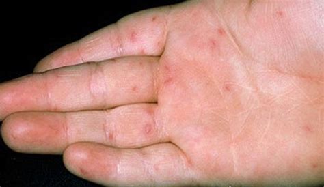 Hand Foot And Mouth Disease How To Spot The Signs And What To Do If