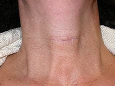 Cicatriz Após Cirurgia Da Tiróide Cirurgia da tiróide minimamente