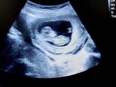 Pregnant Ultrasound Telegraph