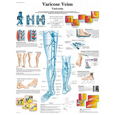 3b Scientific Varicose Veins Chart