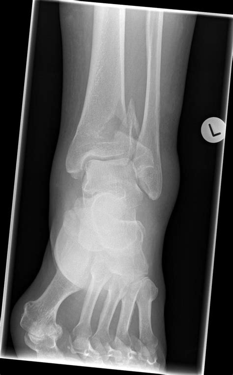Aoota Classification For The Distal Tibial Fracture Wikidoc