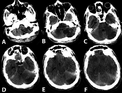 A Ct Scan Showing Right Cerebellar Infarction B Follow Up Ct Scan
