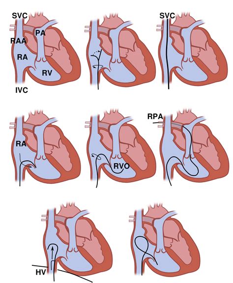 Right Heart Catheterization Pcipedia Heart Catheterization Cath