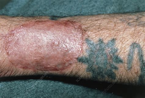 Skin Graft On Arm To Remove Tattoo Stock Image M3360033 Science