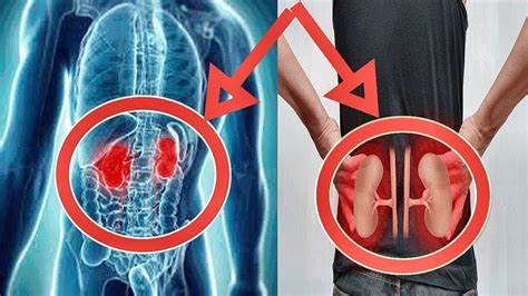 ОПУЩЕНИЕ ПОЧКИ. Ряд ДЕЙСТВИЙ, которые ПОМОГУТ избежать УСУГУБЛЕНИЯ Картинка - ОПУЩЕНИЕ ПОЧКИ. Ряд ДЕЙСТВИЙ, которые ПОМОГУТ избежать УСУГУБЛЕНИЯ