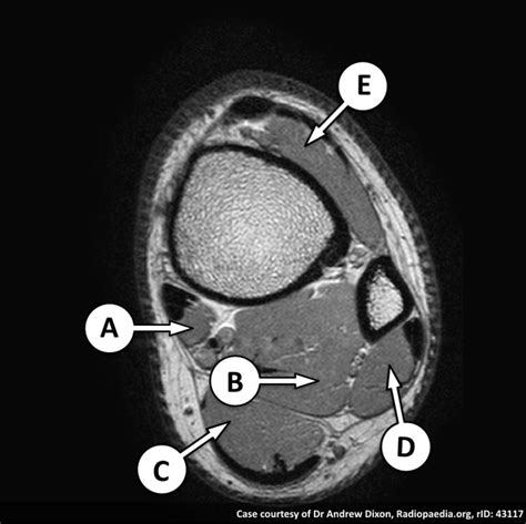 Knee Muscle Anatomy Mri Scroll Through The Structures To Understand