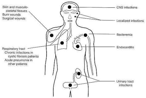 Pseudomonas And Pseudomonas Aeruginosa Infections And Treatment