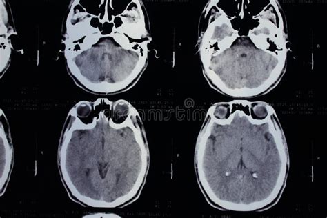 Normal Head On Ct Scans Stock Photo Image Of Human Matter 55979524