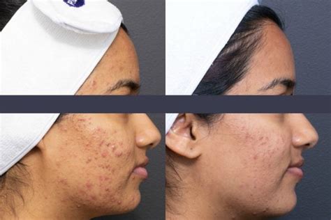 Light Therapy For Skin Does Blue Light Therapy For Acne Work