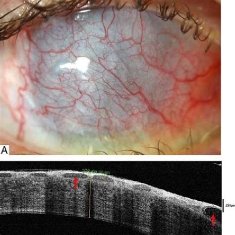 Limbal Stem Cell Deficiency A Fibrovascular Corneal Pannus Slit Lamp