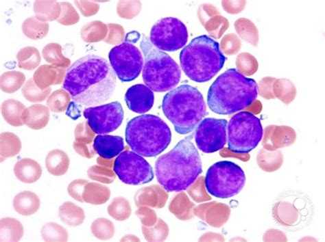 Precursor T Lymphoblastic Leukemialymphoma 2