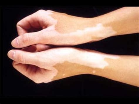 They can be as simple as a sun induced sun allergy or it can be because of dryness what we. How To Cure White Spot On Skin - VITILIGO Treatment ...